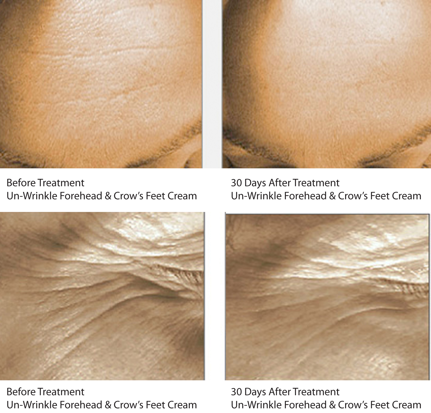Skin 2 Skin's Un-Wrinkle Forehead & Crow;s Feet Cream Before & After